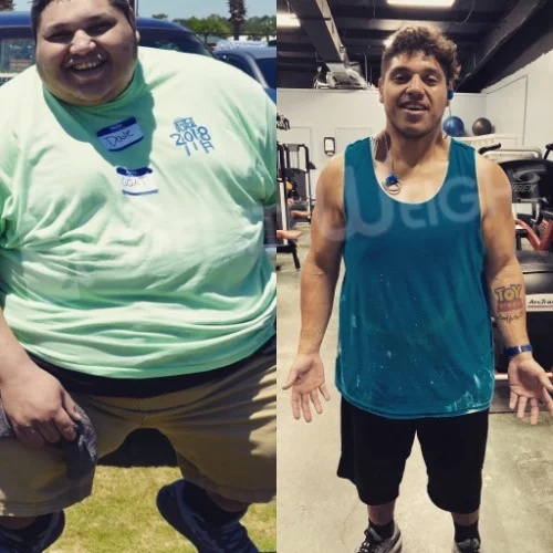 Gastric Sleeve before and after